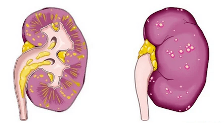 Τι είναι οξεία προστατίτιδα